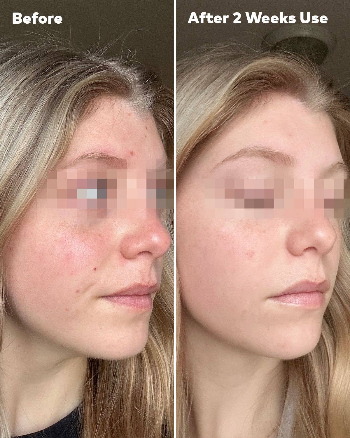 Silver Infused 7-Day Set | For Blemish-Prone Skin: 7-Day Set
