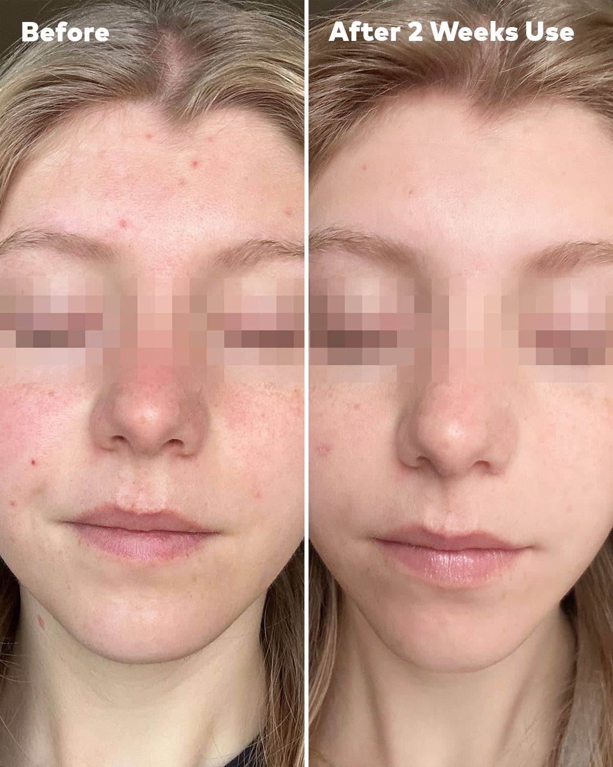 Silver Infused 7-Day Set | For Blemish-Prone Skin: 7-Day Set